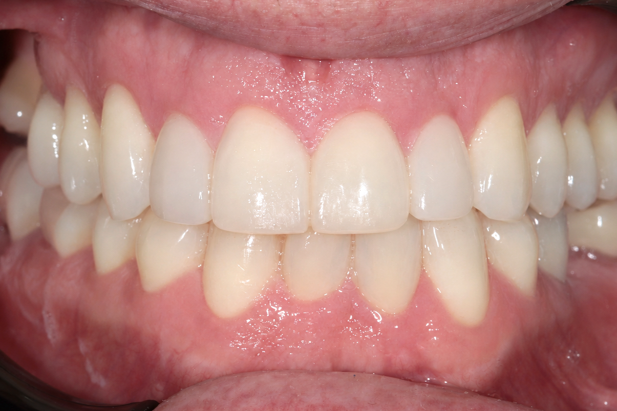 Invisalign and composite bonding for Missing Teeth and Crowding after