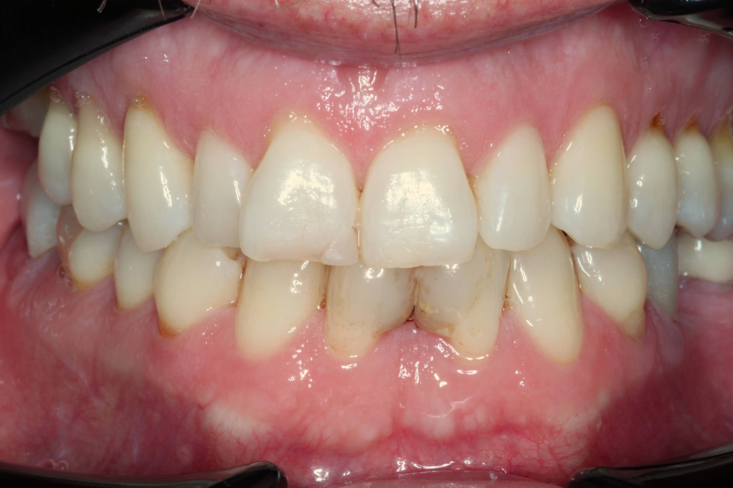 Invisalign and composite bonding for Missing Teeth and Crowding before