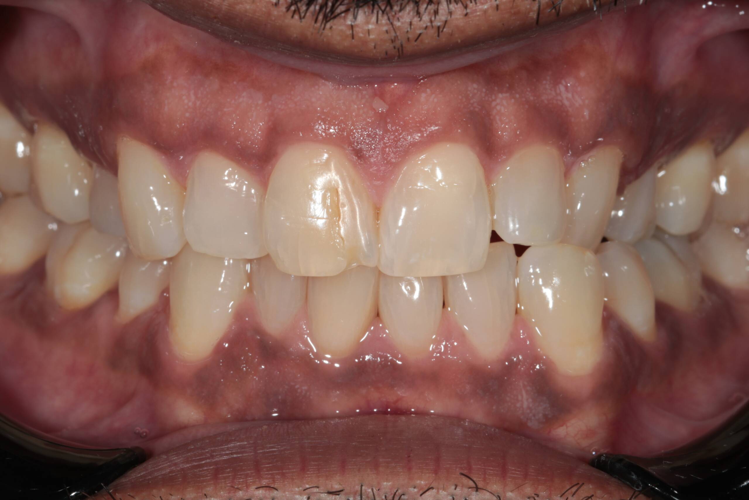 Chipped Teeth and Crossbite Correction BEFORE