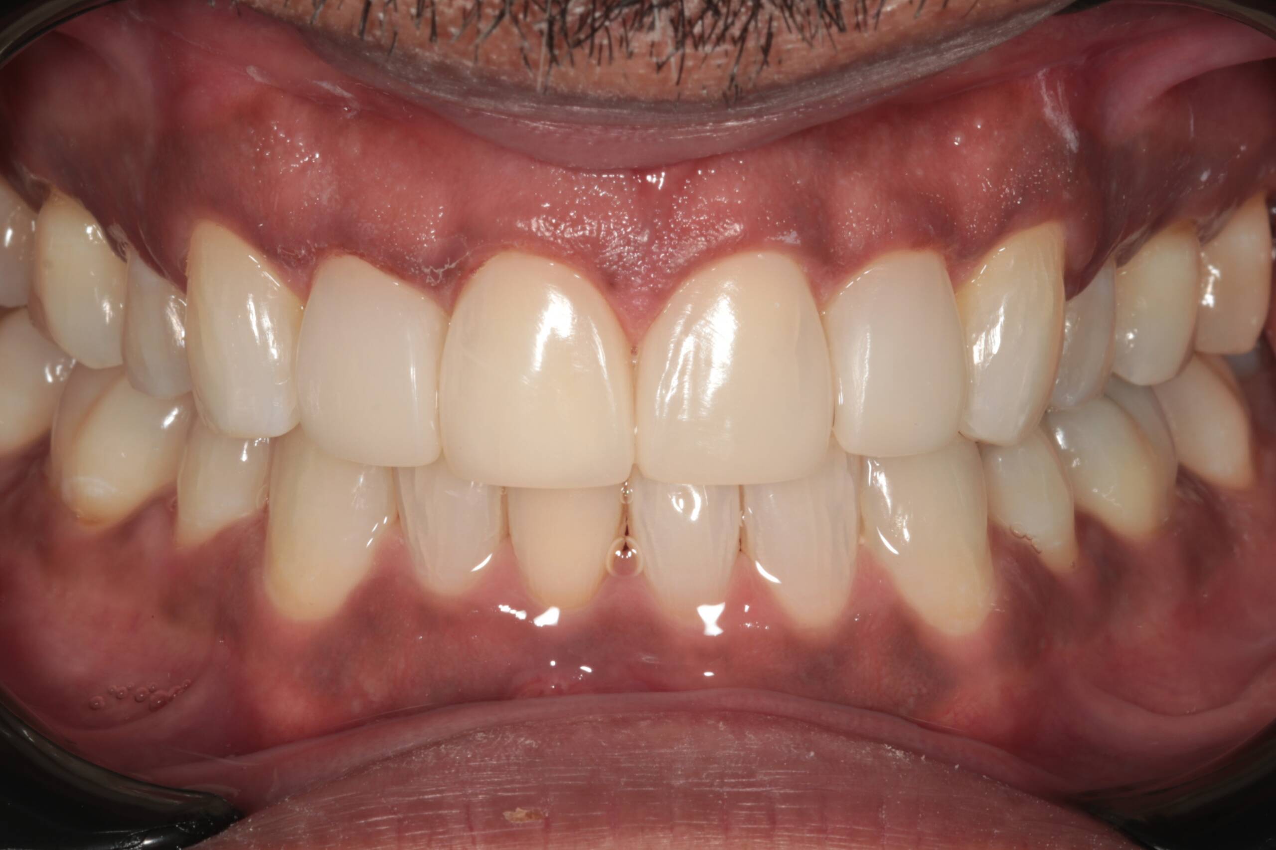Chipped Teeth and Crossbite Correction AFTER
