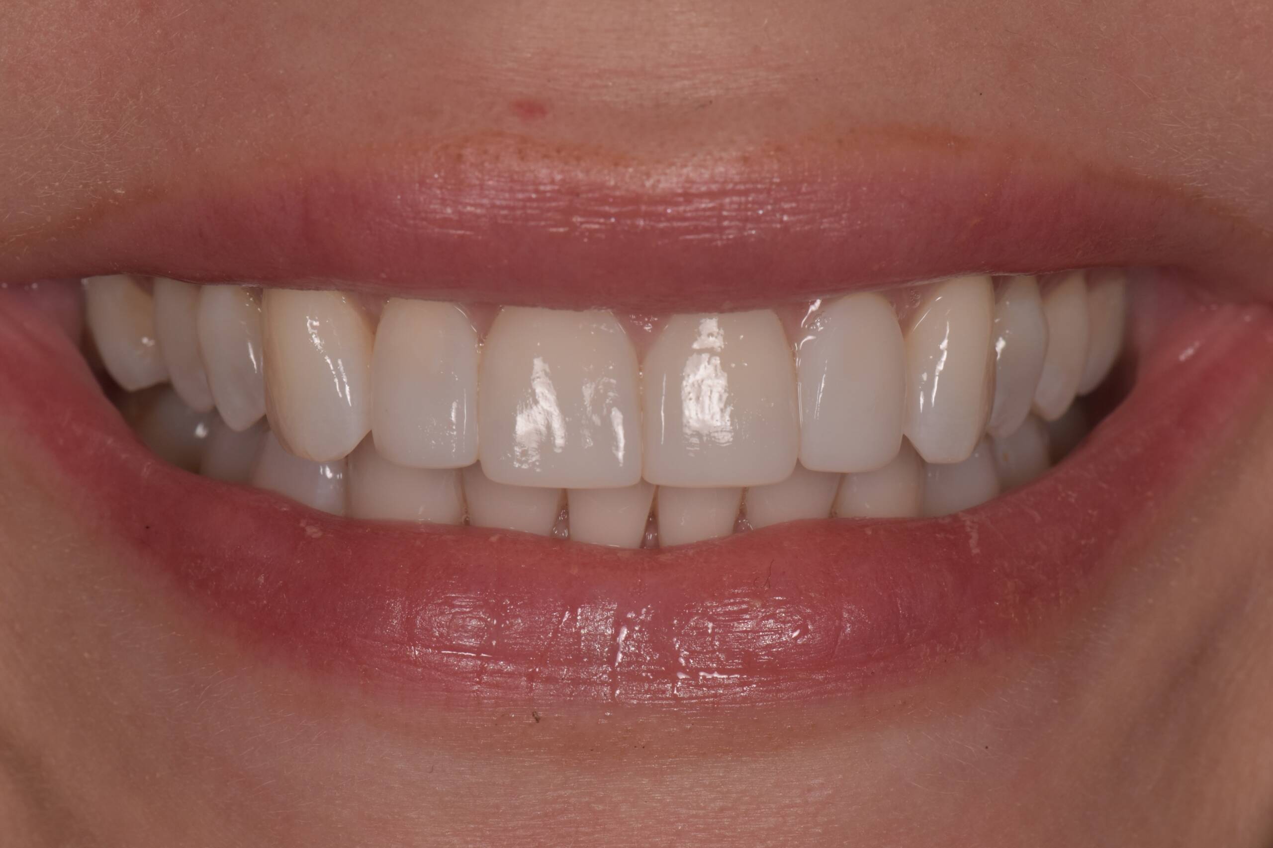Uneven Edges Smile Makeover after Anna