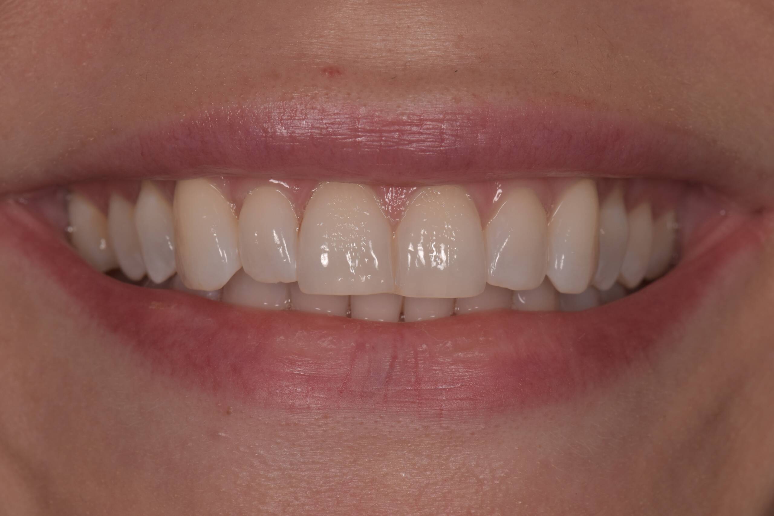 Uneven Edges Smile Makeover before Anna