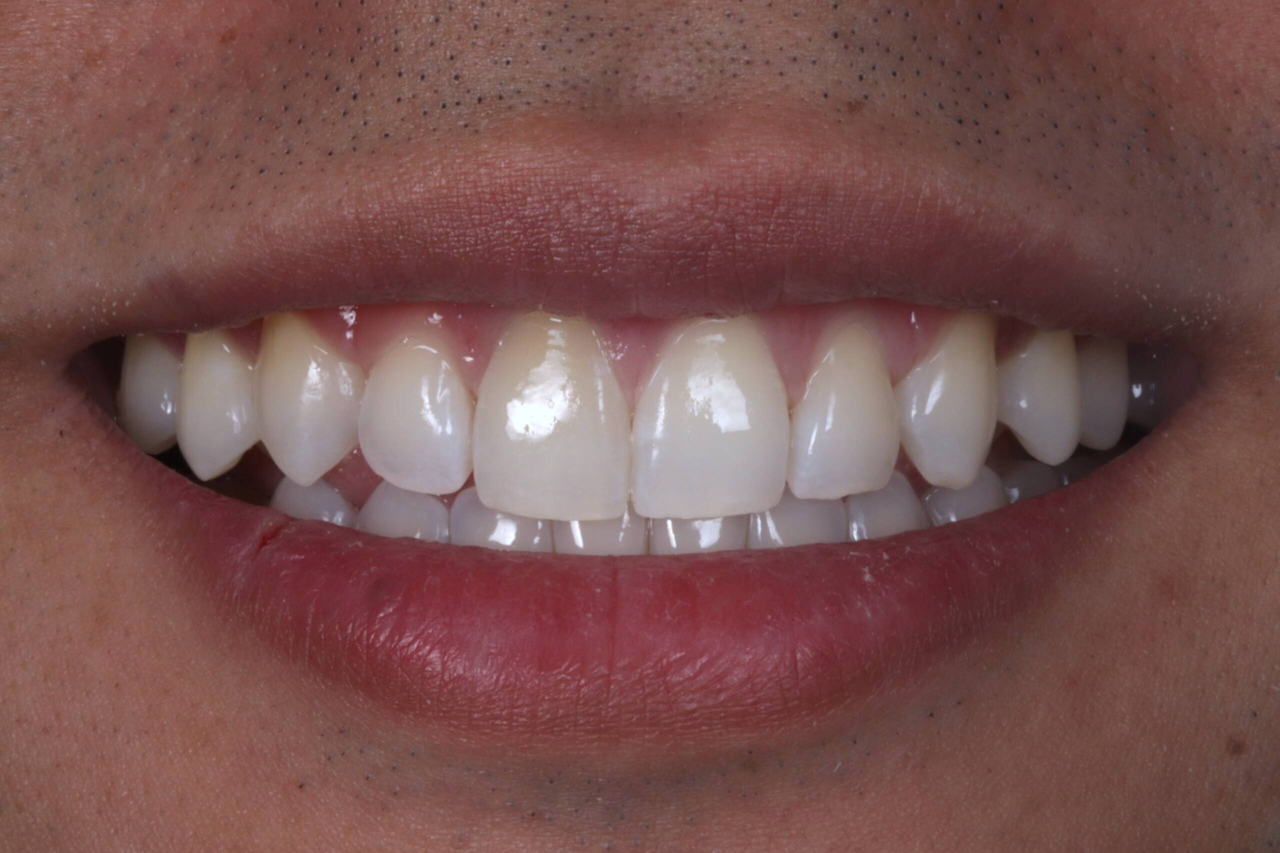 Closing Spaces with Invisalign John AFTER