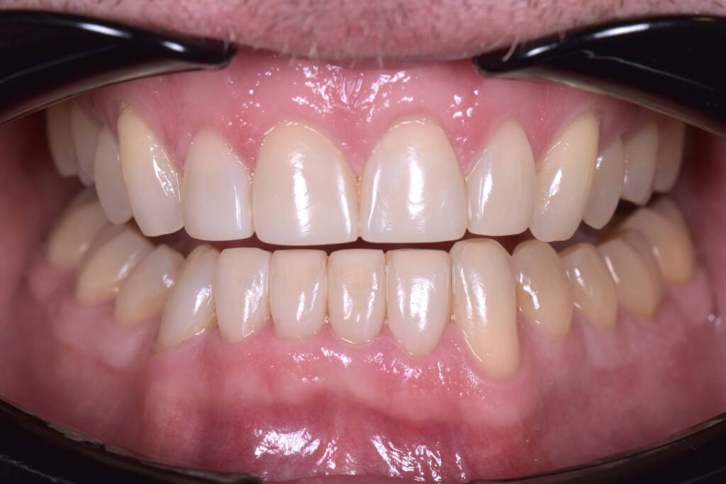 Dr Lisa Kienert composite bonding after