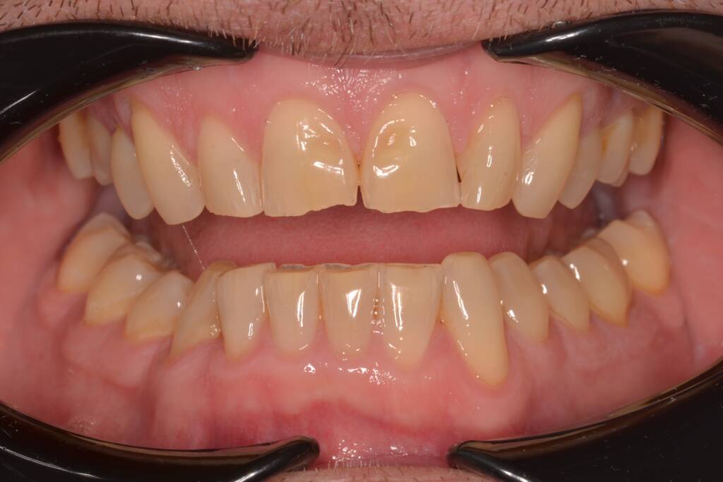 Dr Lisa Kienert composite bonding before