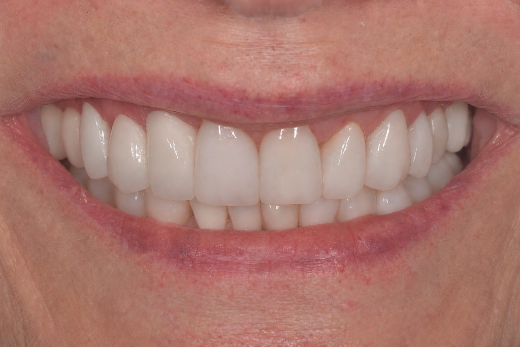 Dr Lisa Kienert porcelain veneers and zirconia bridge after