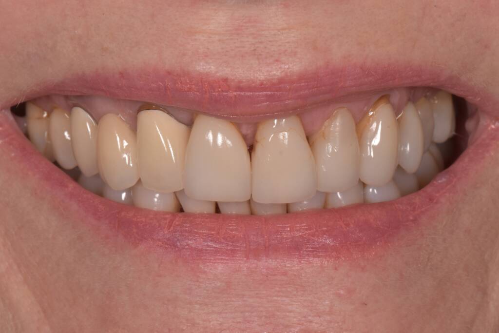 Dr Lisa Kienert porcelain veneers and zirconia bridge before