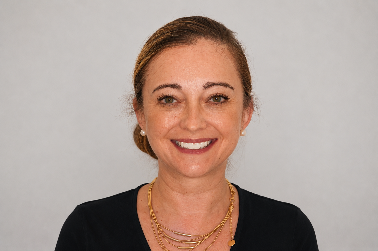 Correcting a V-Shaped Smile with Invisalign and SmileFast Composite bonding