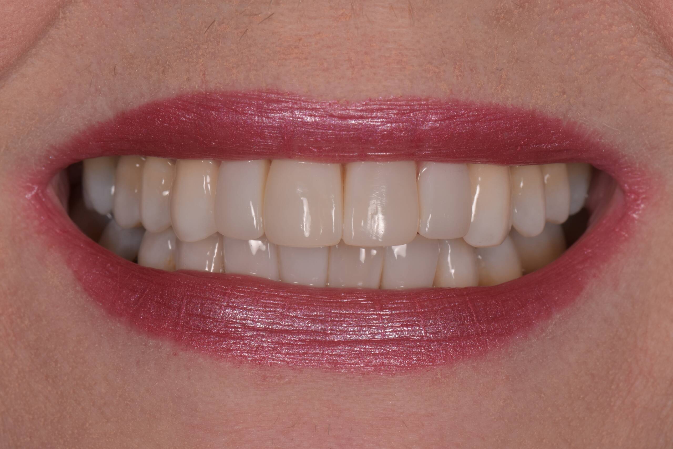 60th birthday smile makeover journey after