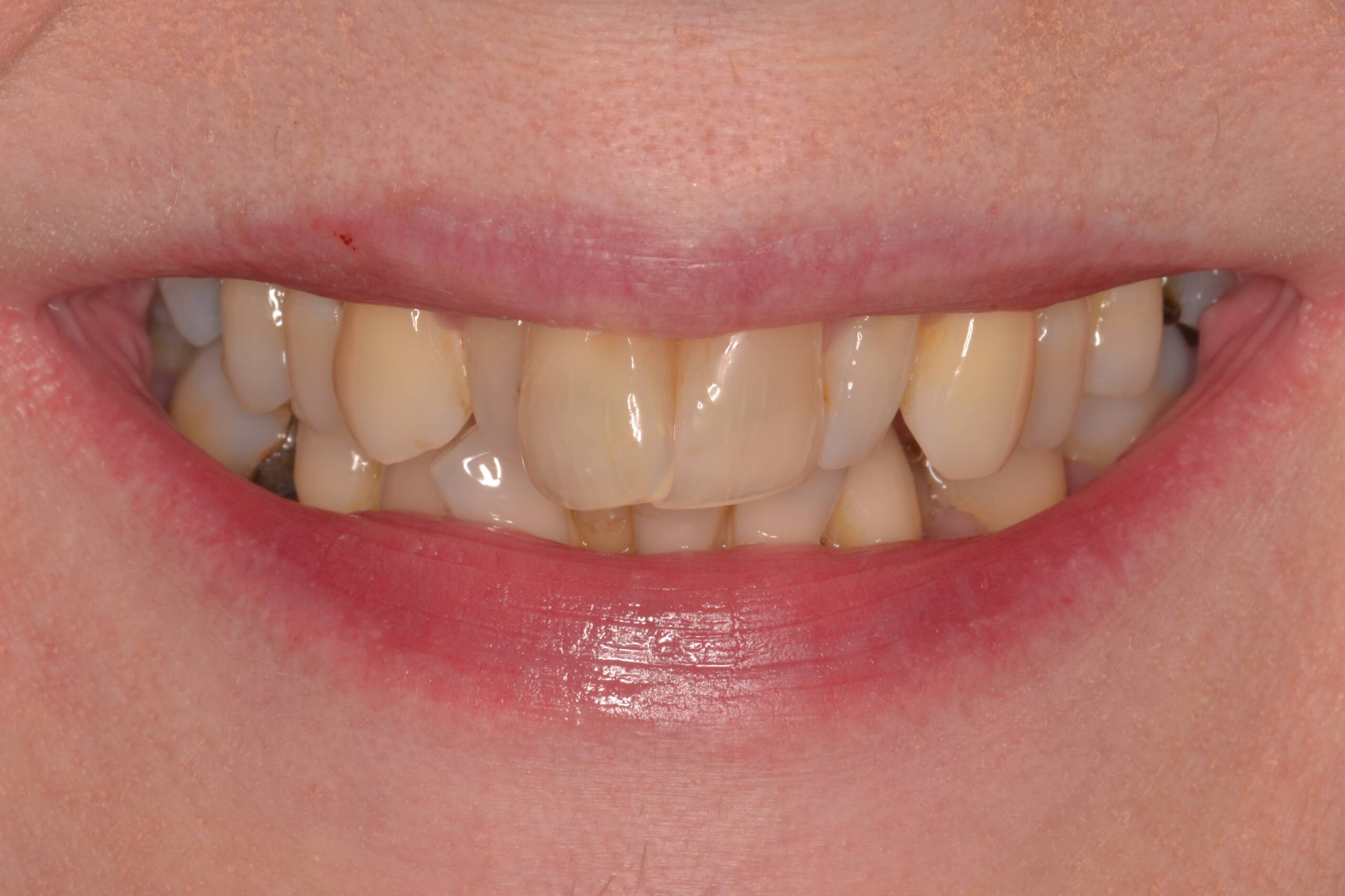 60th birthday smile makeover journey before