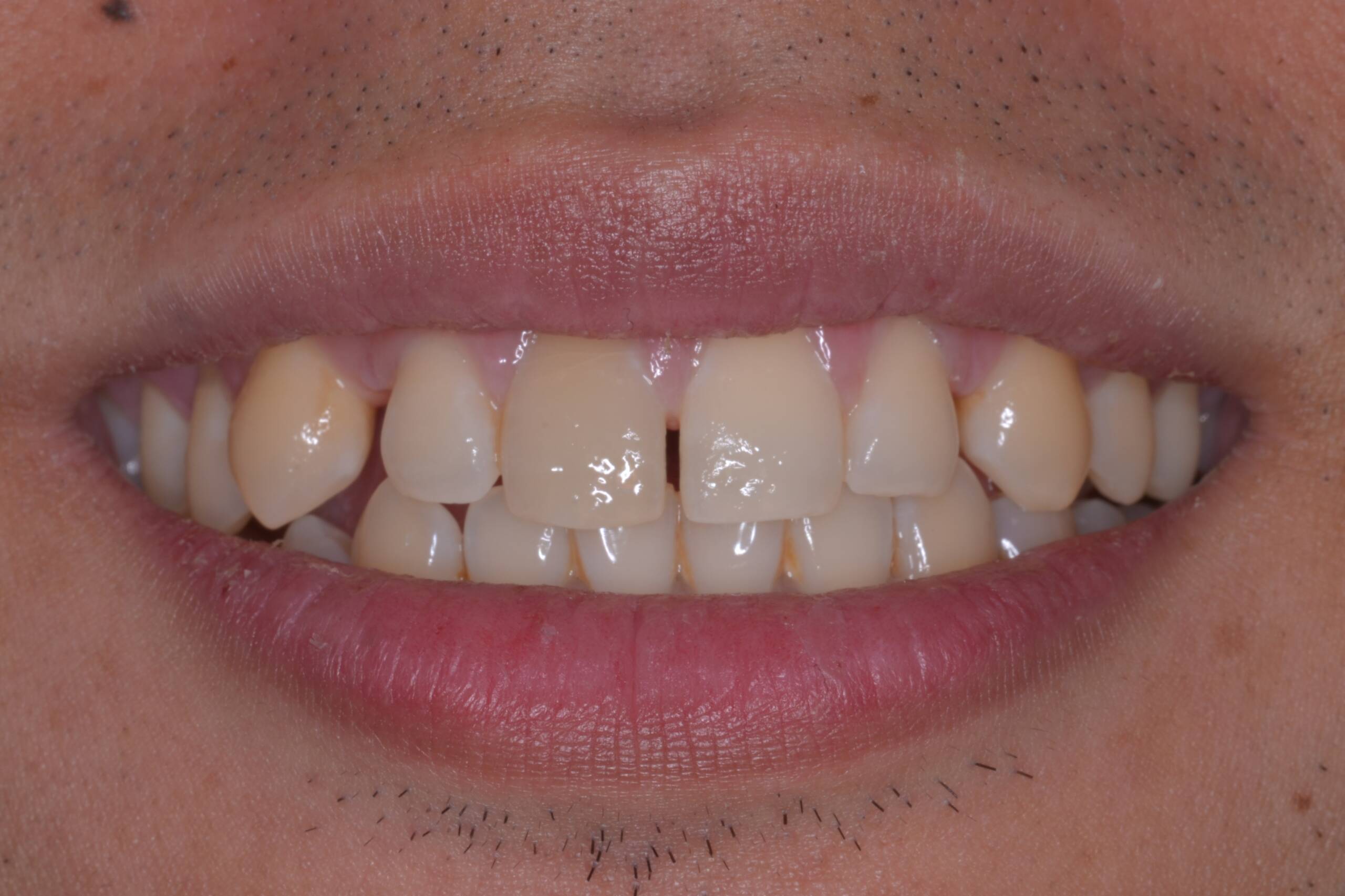 Before