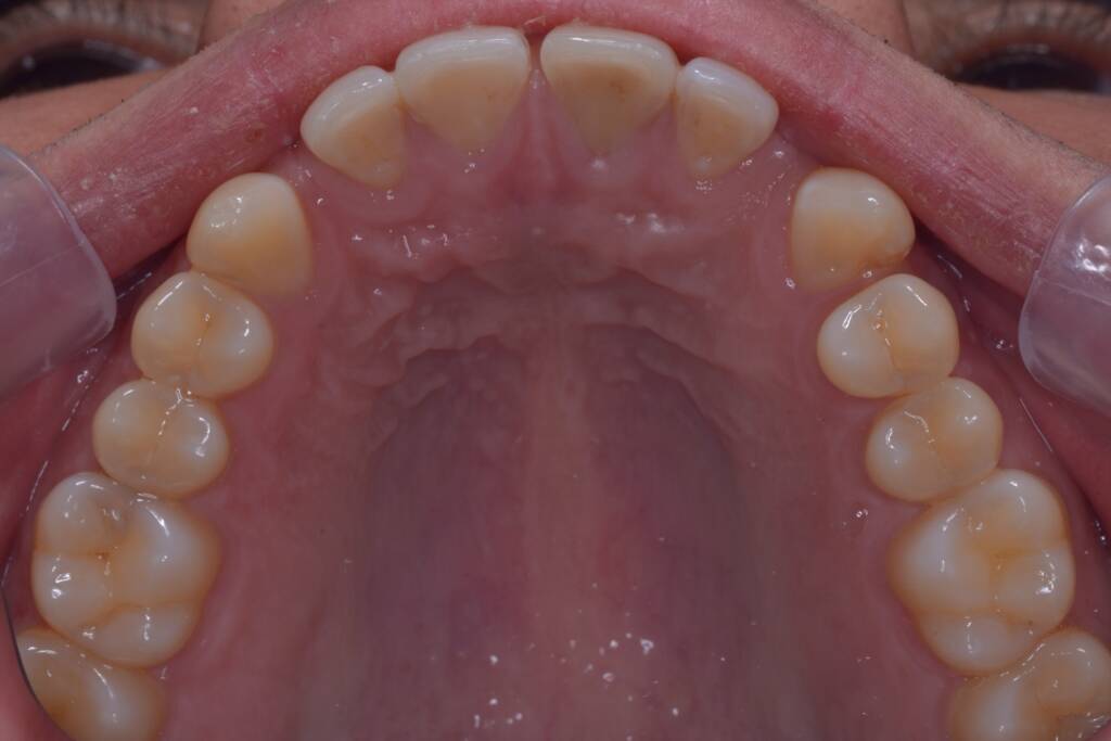 Closing Spaces with Invisalign before upper arch