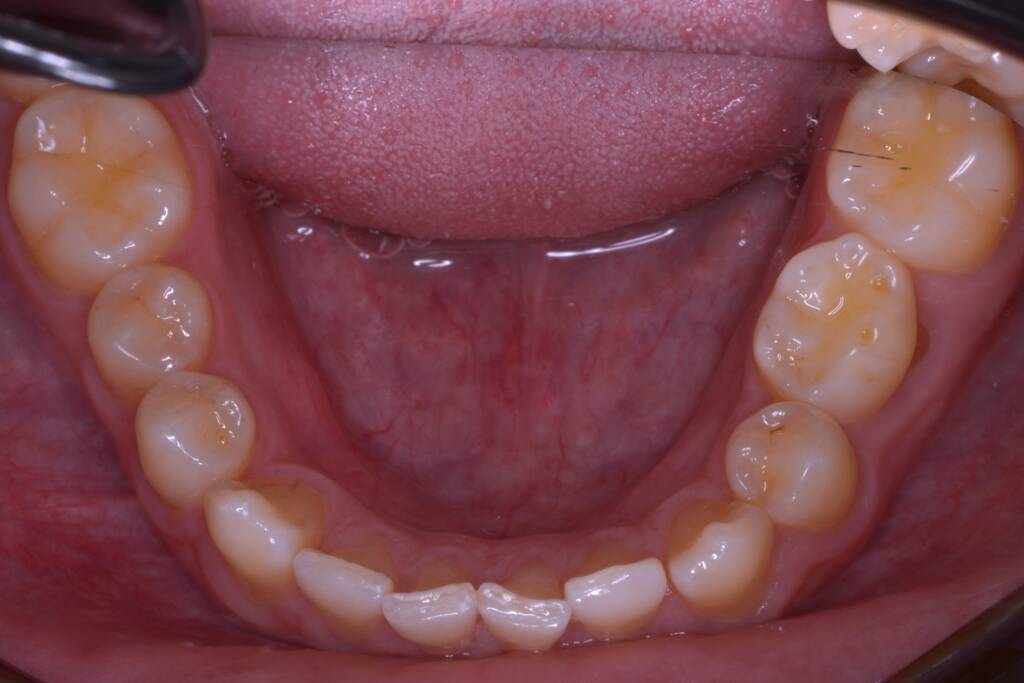 Closing Spaces with Invisalign before lower arch