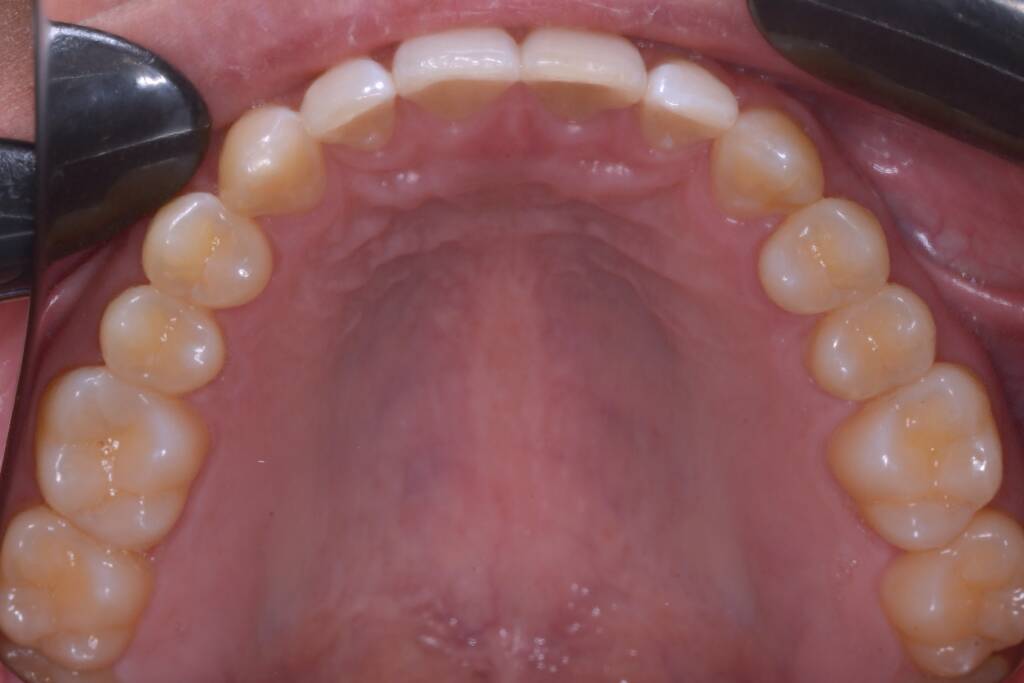 Closing Spaces with Invisalign after upper arch
