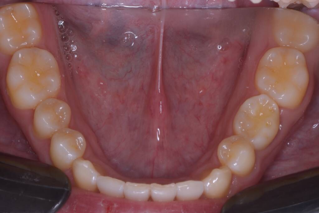 Closing Spaces with Invisalign after lower arch
