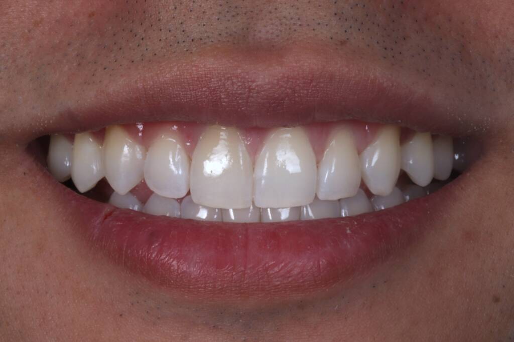 Closing Spaces with Invisalign after smile