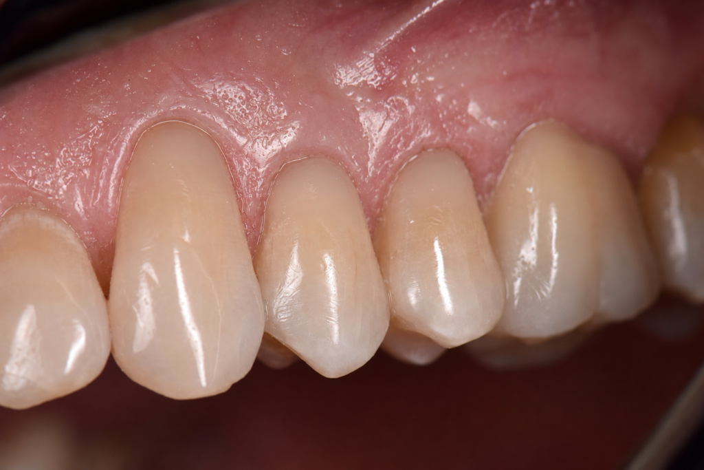 wedge shaped defect after