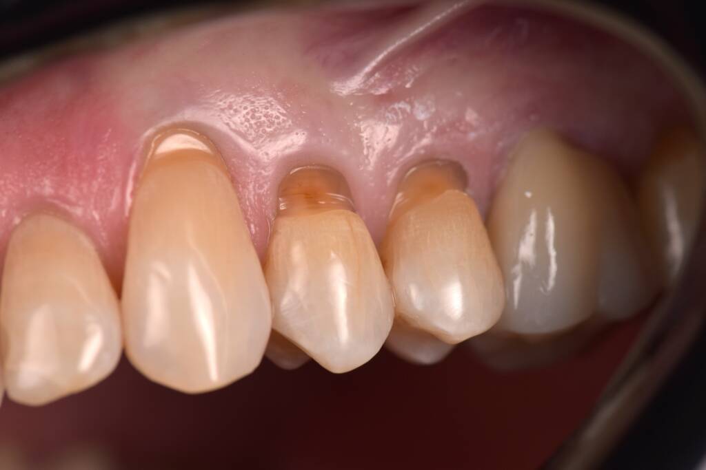 wedge shaped defect before